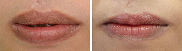 16縮唇修唇手術.jpg 16縮唇修唇手術.jpg