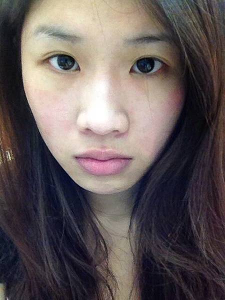 台中格嘉整形 自體脂肪豐頰實例 台中格嘉整形 自體脂肪豐頰實例