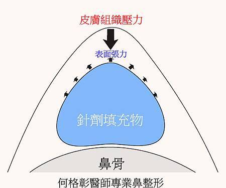 微整隆鼻1 微整隆鼻1