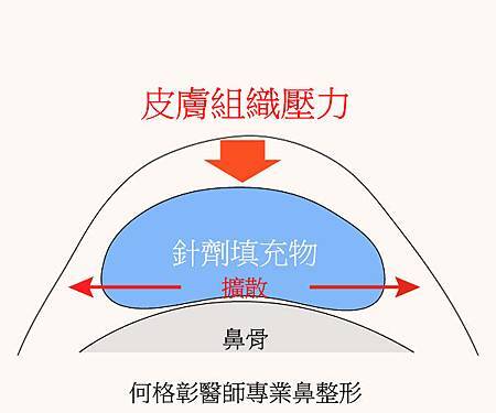 微整隆鼻2 微整隆鼻2