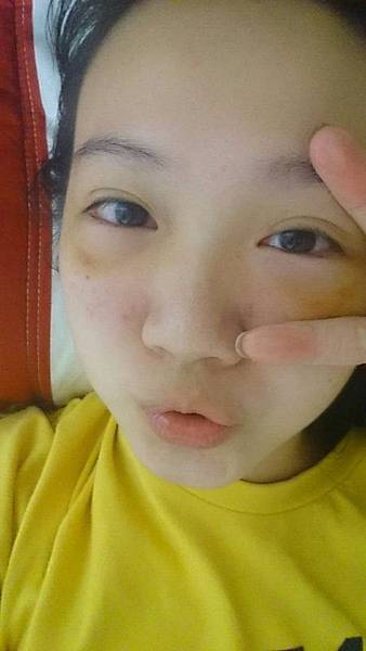 台中無痕眼袋何格彰醫師