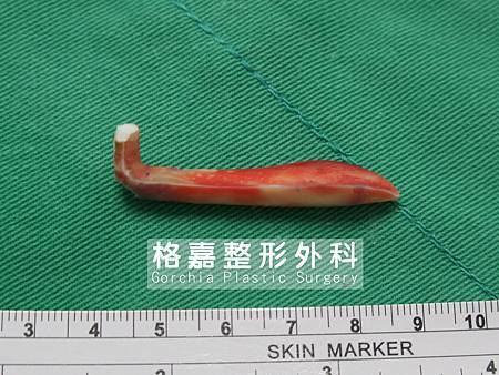 隆鼻感染 隆鼻感染