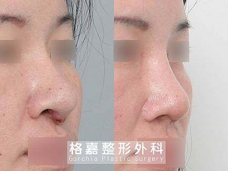 隆鼻感染修復 隆鼻感染修復