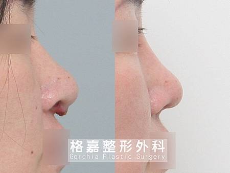 隆鼻感染修復 隆鼻感染修復