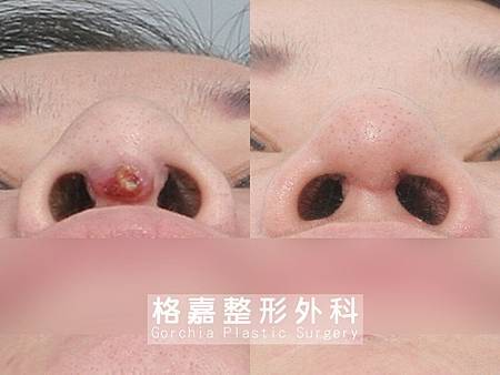 隆鼻感染修復 隆鼻感染修復