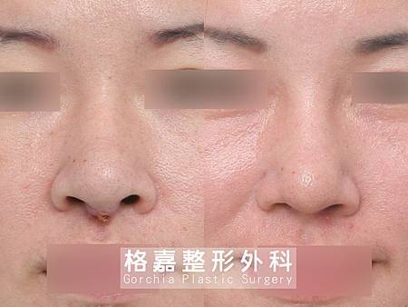 隆鼻感染修復 隆鼻感染修復
