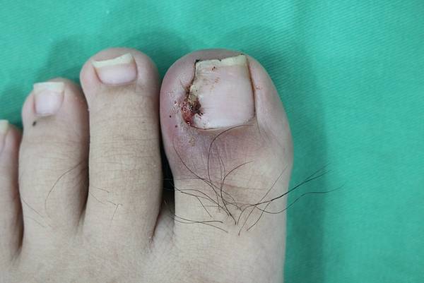 甲溝炎案例一1.jpg 甲溝炎案例一1.jpg