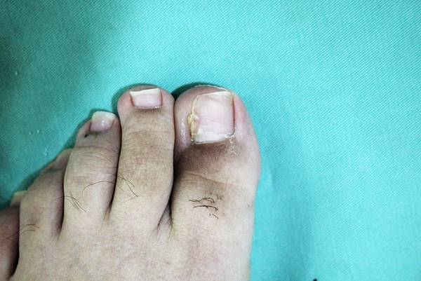 甲溝炎案例一3.jpg 甲溝炎案例一3.jpg