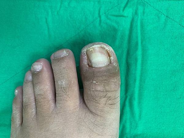 甲溝炎案例二3.jpg 甲溝炎案例二3.jpg