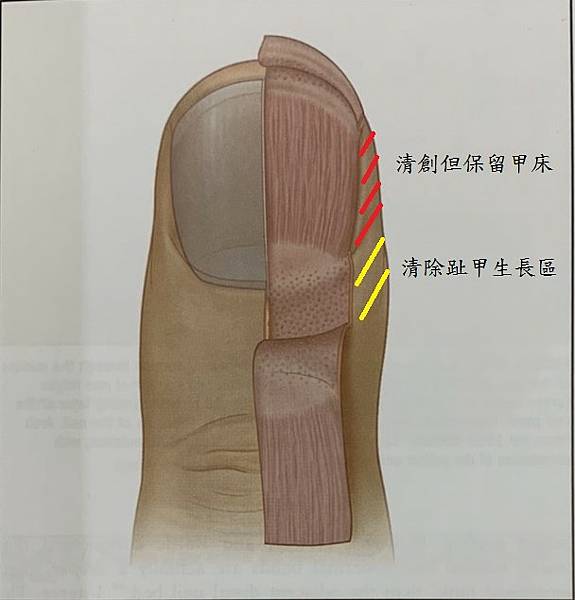 甲溝炎範例２.jpg