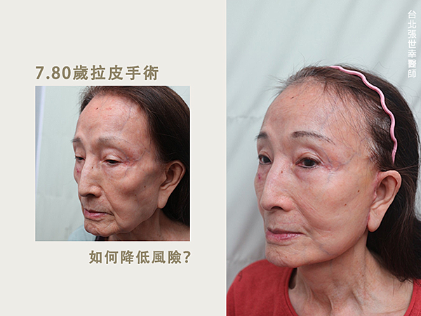image 局部麻醉降低拉皮手術風險