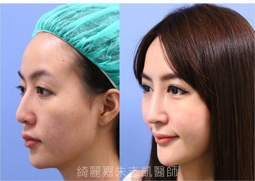 擺脫傳統l型矽膠 擁抱自然俏麗的完美鼻形 L型矽膠 自體軟骨鼻整形 綺麗嘉美型診所 朱志凱醫師美醫部落格 痞客邦 擺脫傳統l型矽膠 擁抱自然俏麗的完美鼻形 L型矽膠 自體軟骨鼻整形 綺麗嘉美型診所 朱志凱醫師美醫部落格 痞客邦