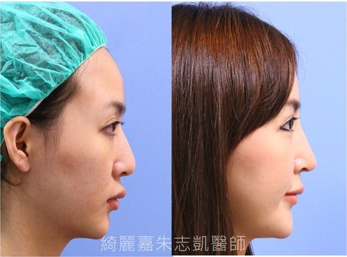 擺脫傳統l型矽膠 擁抱自然俏麗的完美鼻形 L型矽膠 自體軟骨鼻整形 綺麗嘉美型診所 朱志凱醫師美醫部落格 痞客邦