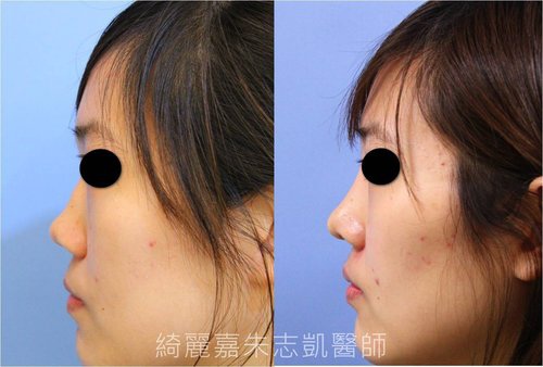 自體軟骨鼻整形 結構式隆鼻 隆鼻手術 結構式隆鼻 自體軟骨 綺麗嘉美型診所 朱志凱醫師美醫部落格 痞客邦 自體軟骨鼻整形 結構式隆鼻 隆鼻手術 結構式隆鼻 自體軟骨 綺麗嘉美型診所 朱志凱醫師美醫部落格 痞客邦