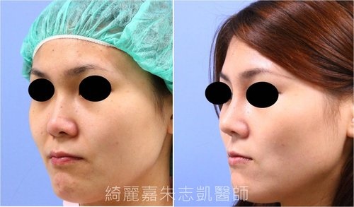 自體軟骨鼻整形 結構式隆鼻 隆鼻手術 結構式隆鼻 自體軟骨 綺麗嘉美型診所 朱志凱醫師美醫部落格 痞客邦