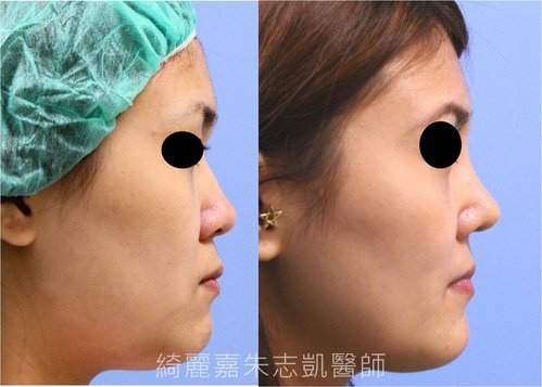 自體軟骨鼻整形 結構式隆鼻 隆鼻手術 結構式隆鼻 自體軟骨 綺麗嘉美型診所 朱志凱醫師美醫部落格 痞客邦 自體軟骨鼻整形 結構式隆鼻 隆鼻手術 結構式隆鼻 自體軟骨 綺麗嘉美型診所 朱志凱醫師美醫部落格 痞客邦