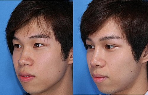 從michael Jackson看鼻整型 推薦 鼻整形 自體軟骨 矽膠隆鼻 Michael Jackson 朱志凱醫師 綺麗嘉美型診所 綺麗嘉美型診所 朱志凱醫師美醫部落格 從michael Jackson看鼻整型 推薦 鼻整形 自體軟骨 矽膠隆鼻 Michael Jackson 朱志凱醫師 綺麗嘉美型診所 綺麗嘉美型診所 朱志凱醫師美醫部落格