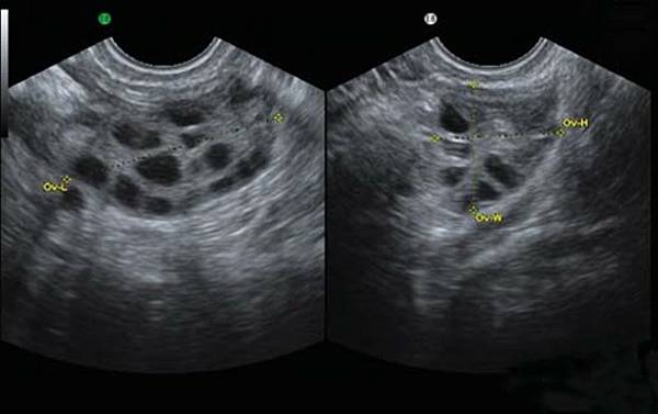 多囊卵巢照腹部超音波濾泡多