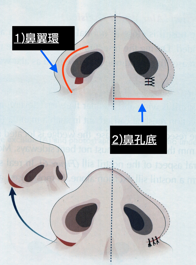 鼻翼手術分為鼻翼環與鼻孔底調整,鼻翼手術,博恩妍