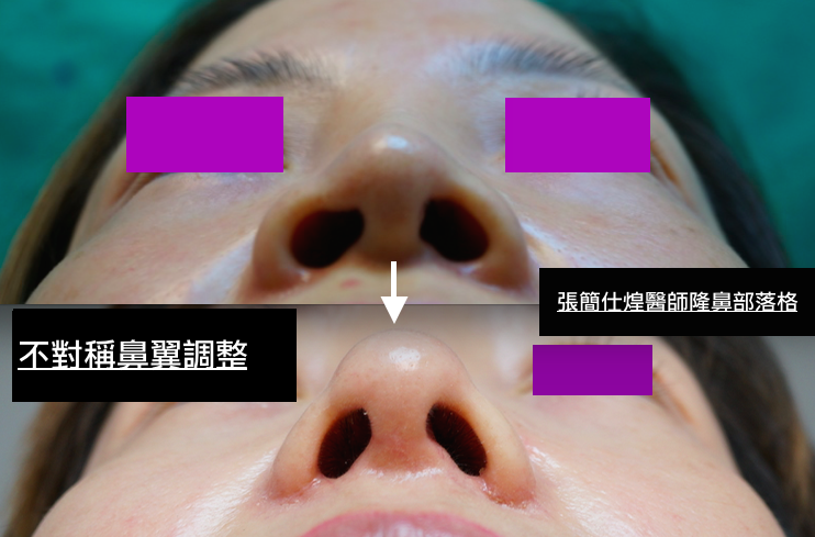 不對稱鼻翼手術,鼻翼重修,鼻翼手術,博恩妍