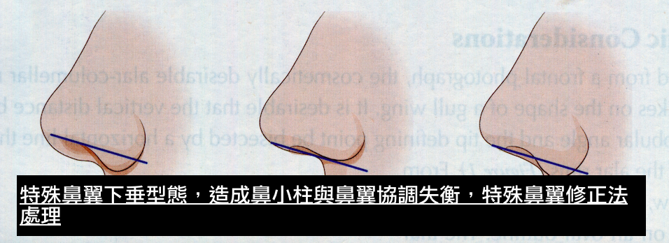 特殊鼻翼下垂型態需要鼻翼手術調整,鼻翼手術,博恩妍