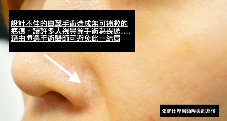 鼻翼手術疤痕,博恩妍