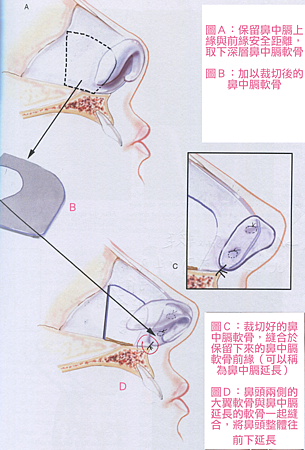 隆鼻推薦掀開式法,隆鼻推薦,博恩妍