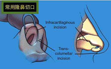 隆鼻推薦鼻內入法,隆鼻推薦,博恩妍