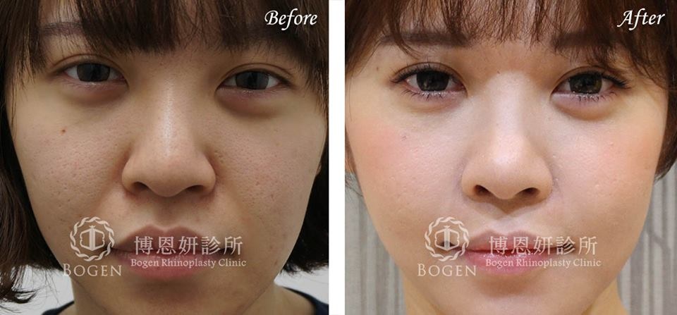 人工骨片鼻重修+法令紋貴族手術,鼻重修,法令紋,博恩妍