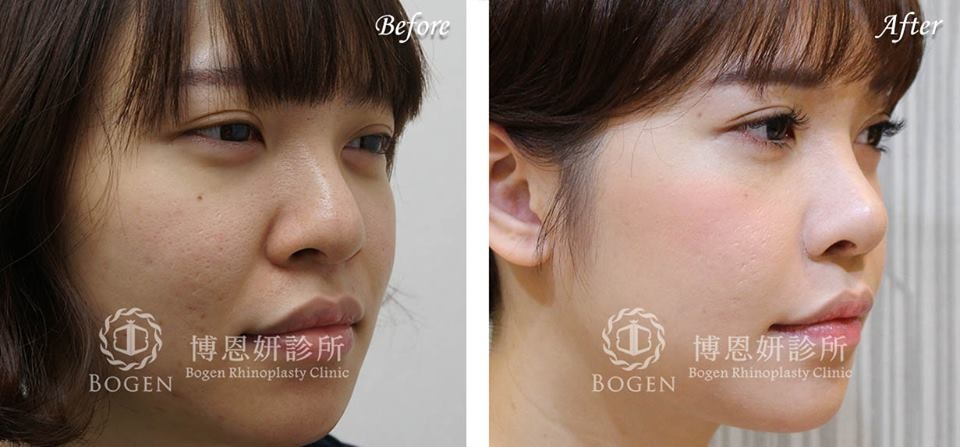 人工骨片鼻重修+法令紋貴族手術,鼻重修,法令紋,博恩妍