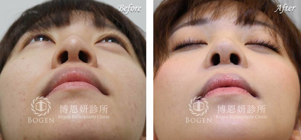 人工骨片鼻重修+法令紋貴族手術,鼻重修,法令紋,博恩妍