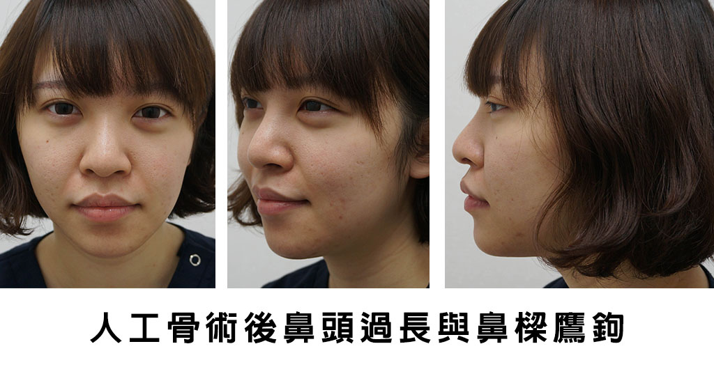 人工骨片隆鼻導致鼻頭過長與鼻樑鷹鉤,博恩妍