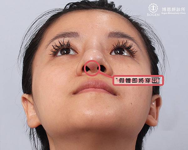 隆鼻假體穿出,隆鼻發炎感染,博恩妍