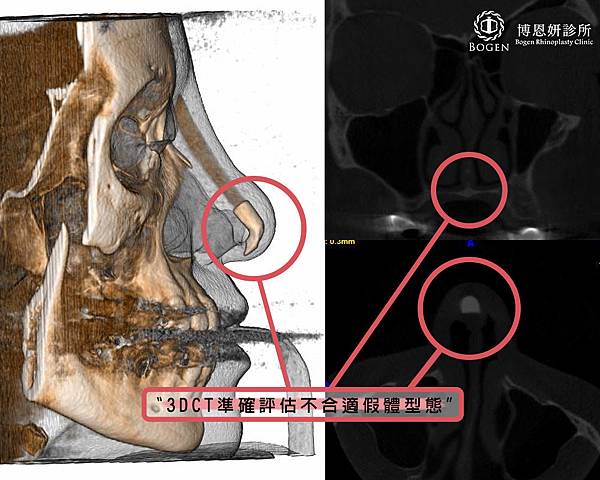 3D電腦斷層,鼻重修,博恩妍