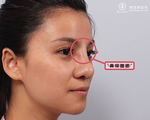 鼻樑腫脹,隆鼻發炎感染,博恩妍