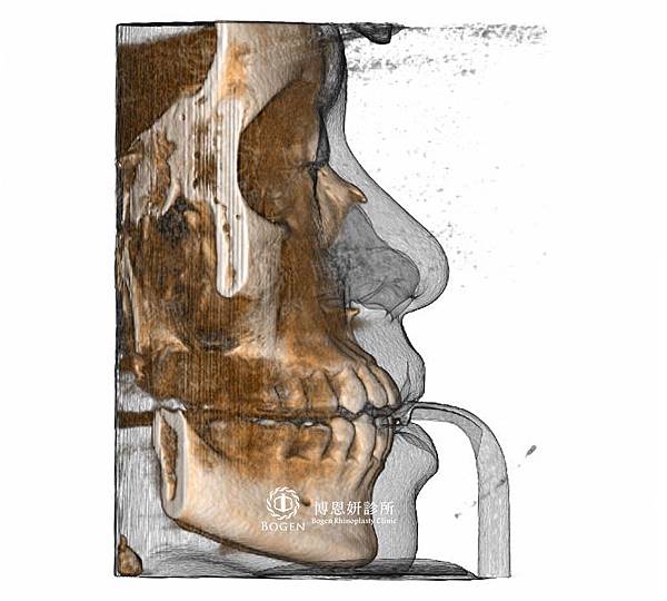 晶亮瓷隆鼻CT拍射,博恩妍診所