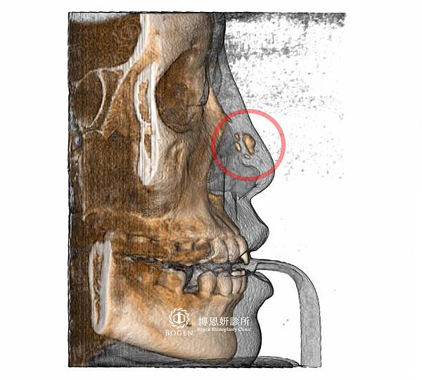 晶亮瓷隆鼻CT拍射,張簡醫師