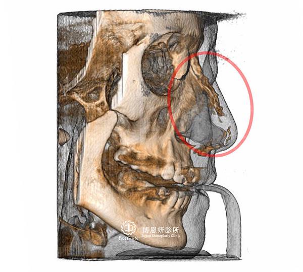 晶亮瓷隆鼻CT拍射,博恩妍診所