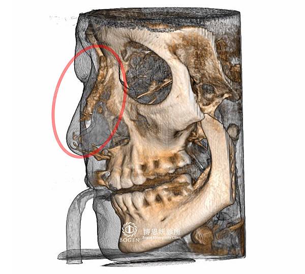 晶亮瓷隆鼻CT拍射,博恩妍診所