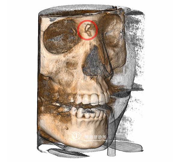晶亮瓷隆鼻CT拍射,博恩妍診所