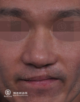 唇裂鼻患者鼻孔不對稱,,唇裂鼻,博恩妍