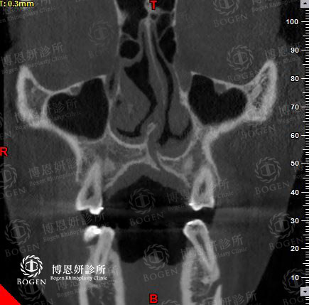唇裂鼻患者鼻中隔彎曲,唇裂鼻,鼻中隔彎曲,博恩妍