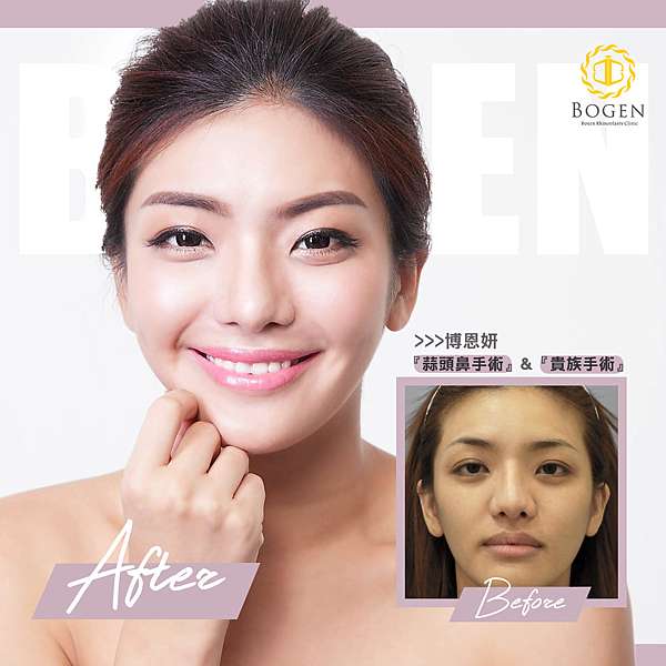 博恩妍大馬見面會後記 台灣鼻整形醫師觀點看馬來西亞鼻整形與鼻重修現況 張簡仕煌醫師隆鼻部落格 痞客邦版 痞客邦 博恩妍大馬見面會後記 台灣鼻整形醫師觀點看馬來西亞鼻整形與鼻重修現況 張簡仕煌醫師隆鼻部落格 痞客邦版 痞客邦