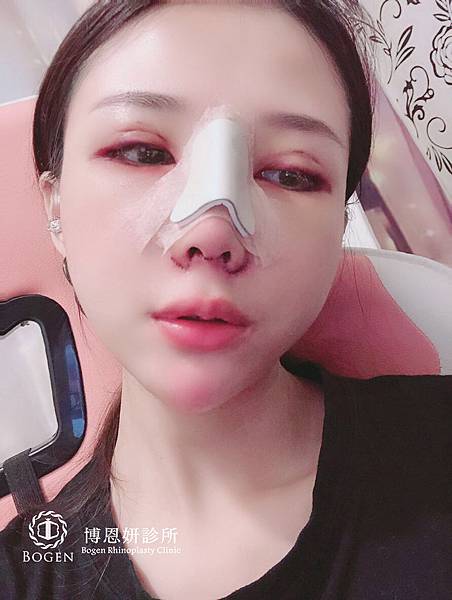 鼻骨調整(敲鼻骨)隆鼻術後鼻模板,敲鼻骨,博恩妍