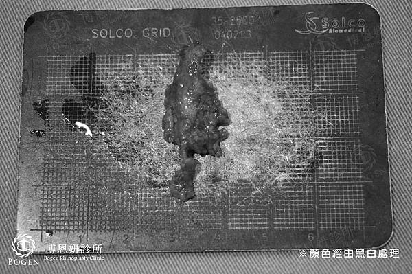 珍珠肋軟骨隆鼻重修,博恩妍