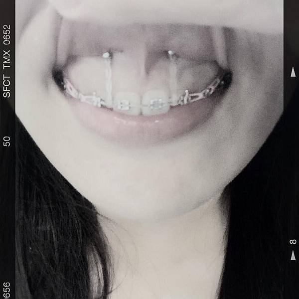 牙齒矯正 矯正第460天 打人中骨釘了 廢物ol的生活雜事 痞客邦