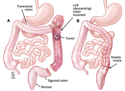 Left Colectomy