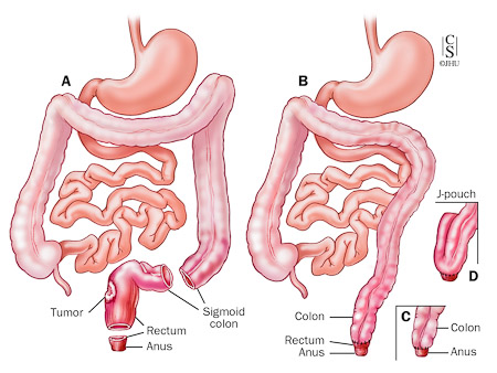 Extended Low Anterior Resection