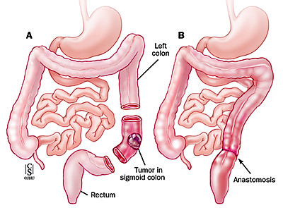 Sigmoid Colectomy