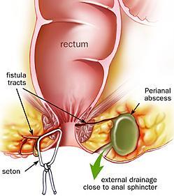 Crohns and anal fistula - Hot video and anal fistula Crohns